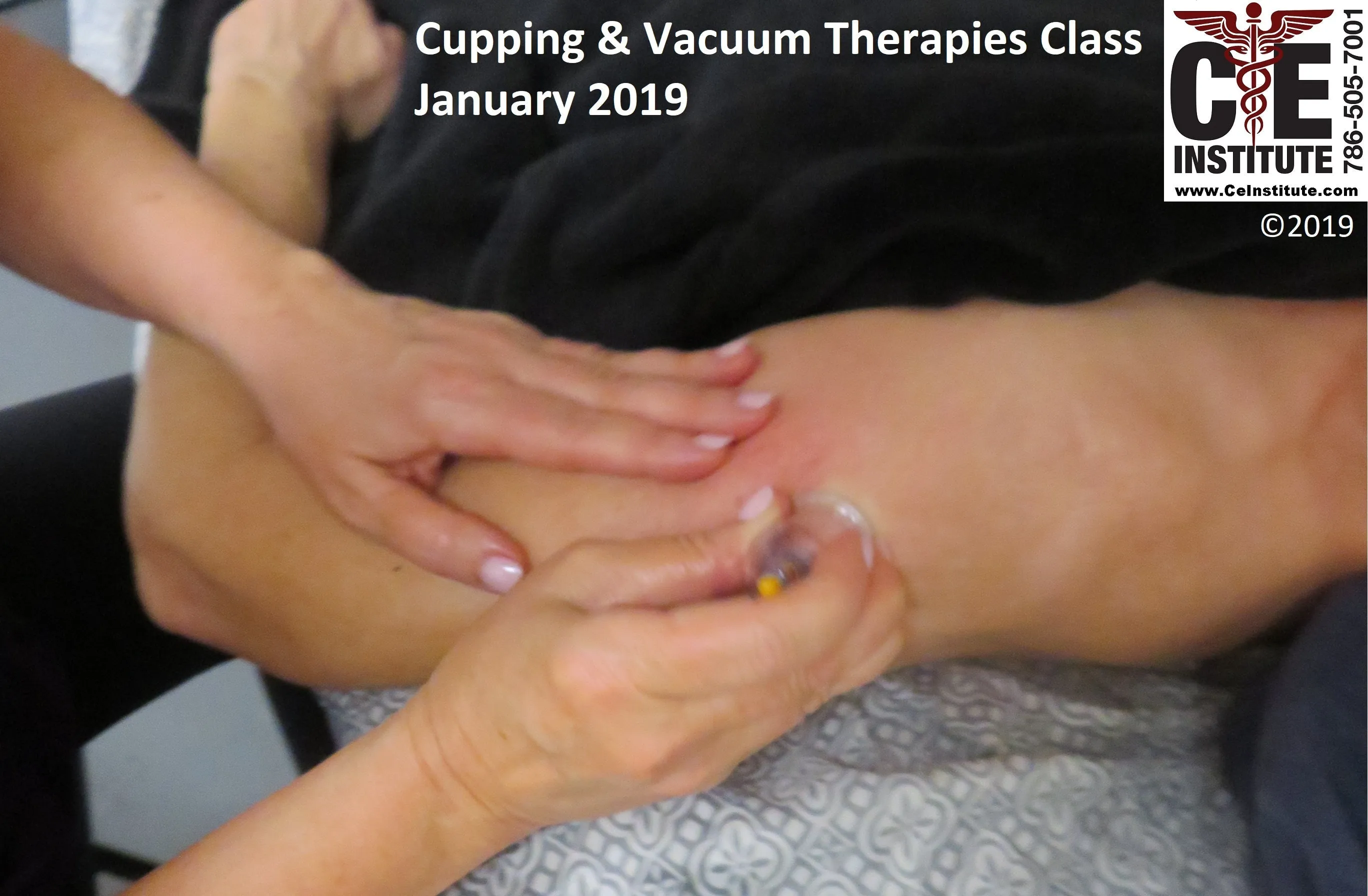 18 CE Hour Advanced Myofascial Cupping (Computer-Based Live Interactive Webinar)